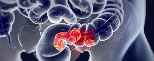 American Journal of Gastroenterology: четыре типа боли могут сигнализировать о раке кишечника