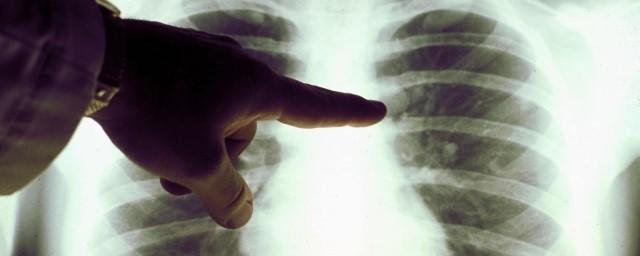 Онколог Гончарова назвала деформацию пальцев симптомом рака легкого