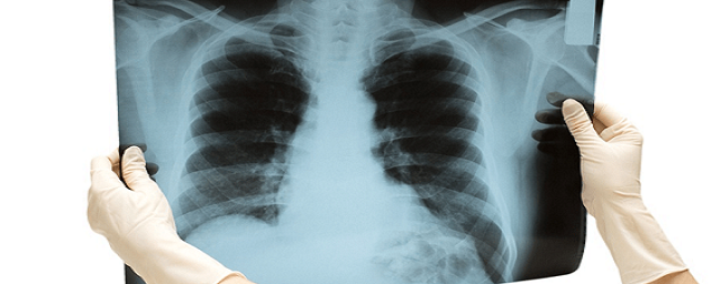 Немецкие ученые предупредили о разрушительном воздействии рентгена на кости