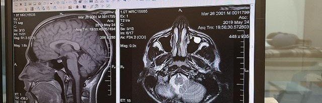 Головокружение и зрительные патологии указывают на рак мозга