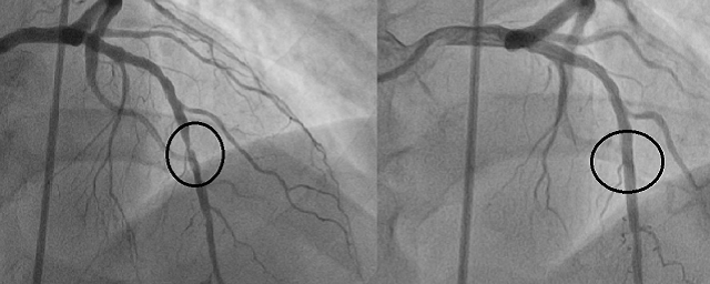 Специалисты Сеченовского университета разработали технологию отсроченного стентирования артерий при инфаркте