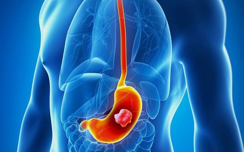 Онколог Кит назвал первые симптомы рака желудка