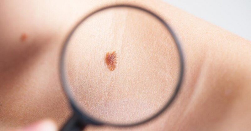 Российские ученые повысили точность диагностики рака кожи с помощью нейросети