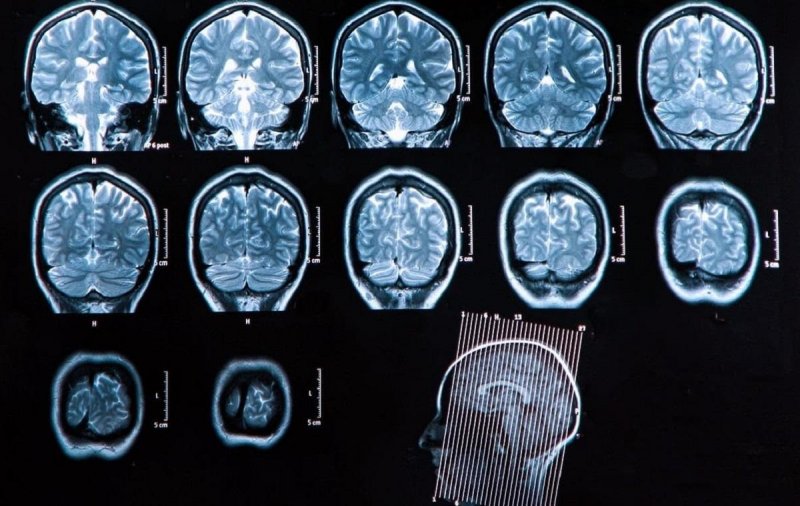 Исследования выявили побочные действия препаратов от Альцгеймера