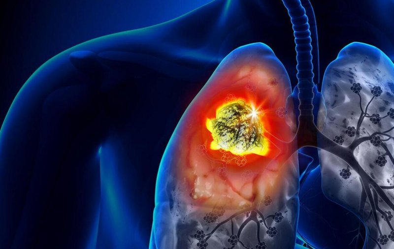 Врач Басанов: Курение, недостаток сна, горячая еда могут спровоцировать развитие онкологических заболеваний