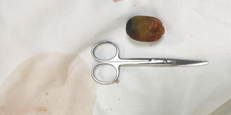 КРАСНОДАР. Краснодарские хирурги прооперировали пациентку с редким осложнением, удалив большой желчный камень