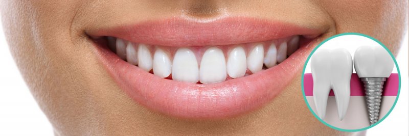 Имплантация зубов: как вернуть улыбку и жевательную функцию даже в самых сложных случаях