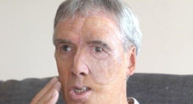 75-летний британец получил 3D-протез лица после аварии и сделал неожиданное открытие