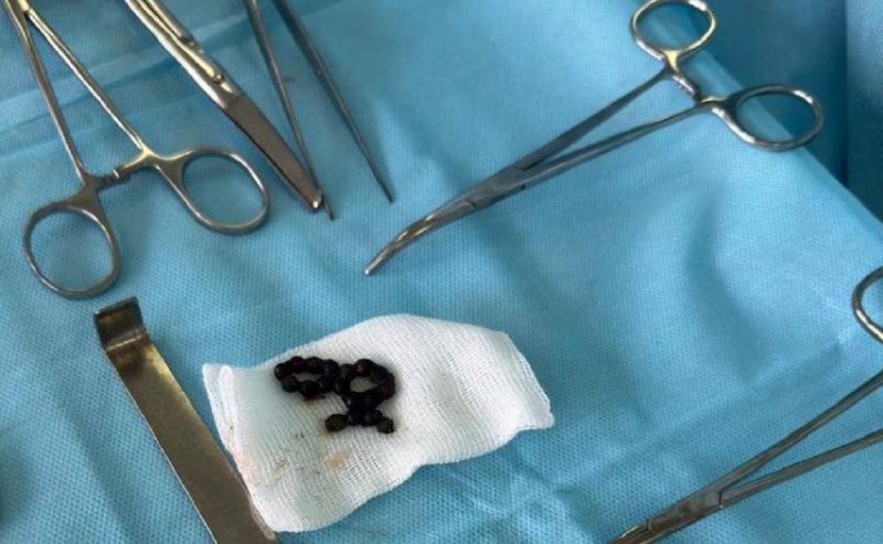СТАВРОПОЛЬЕ. На Ставрополе хирурги ужаснулись находке в кишечнике трёхлетнего ребенка