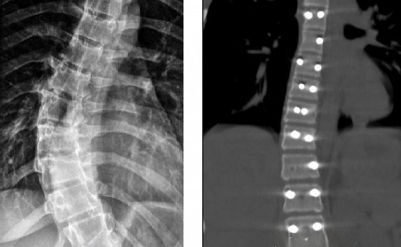СТАВРОПОЛЬЕ. Нейрохирурги Ставрополя провели уникальную операцию пациентке с изгибом позвоночника в 40 градусов