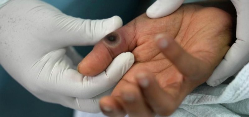 В Индии выявлен опасный африканский штамм оспы обезьян Clade Ib